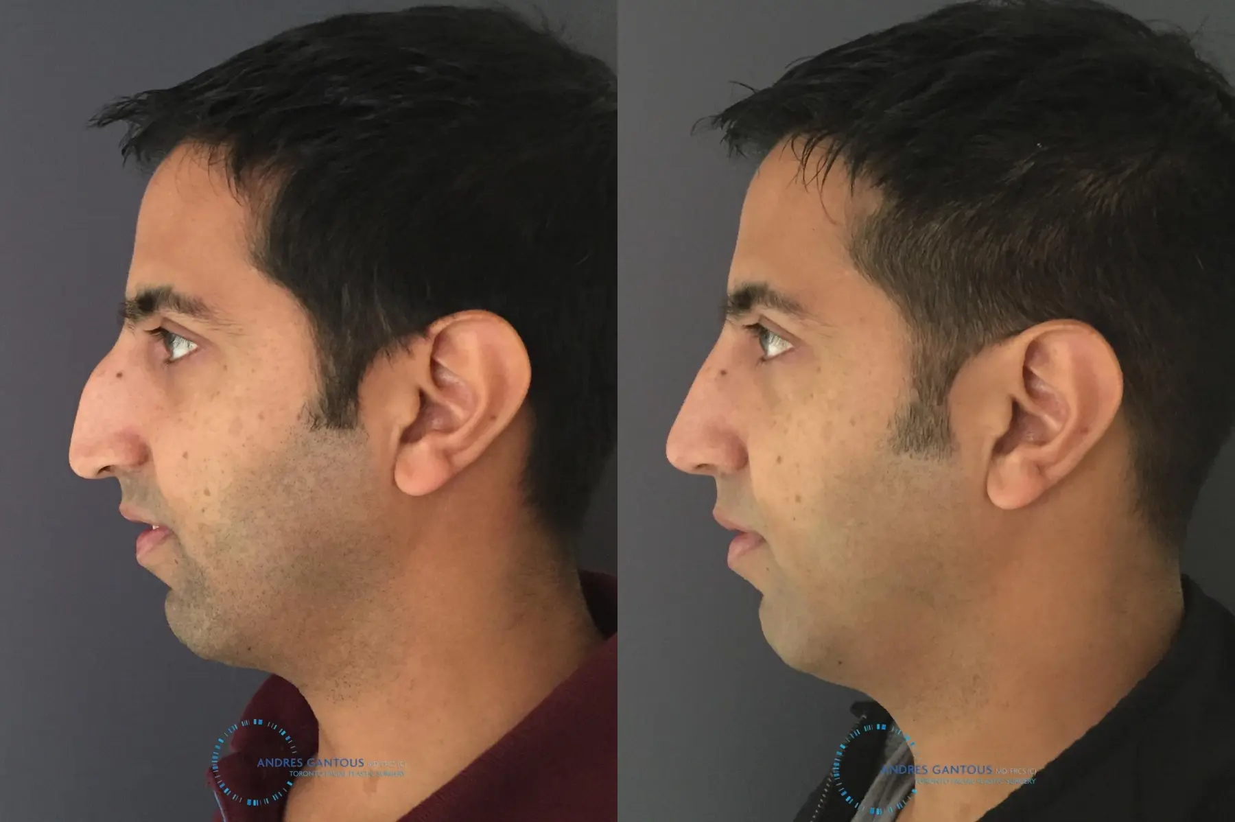 Rhinoplasty: Patient 76 - Before and After 6