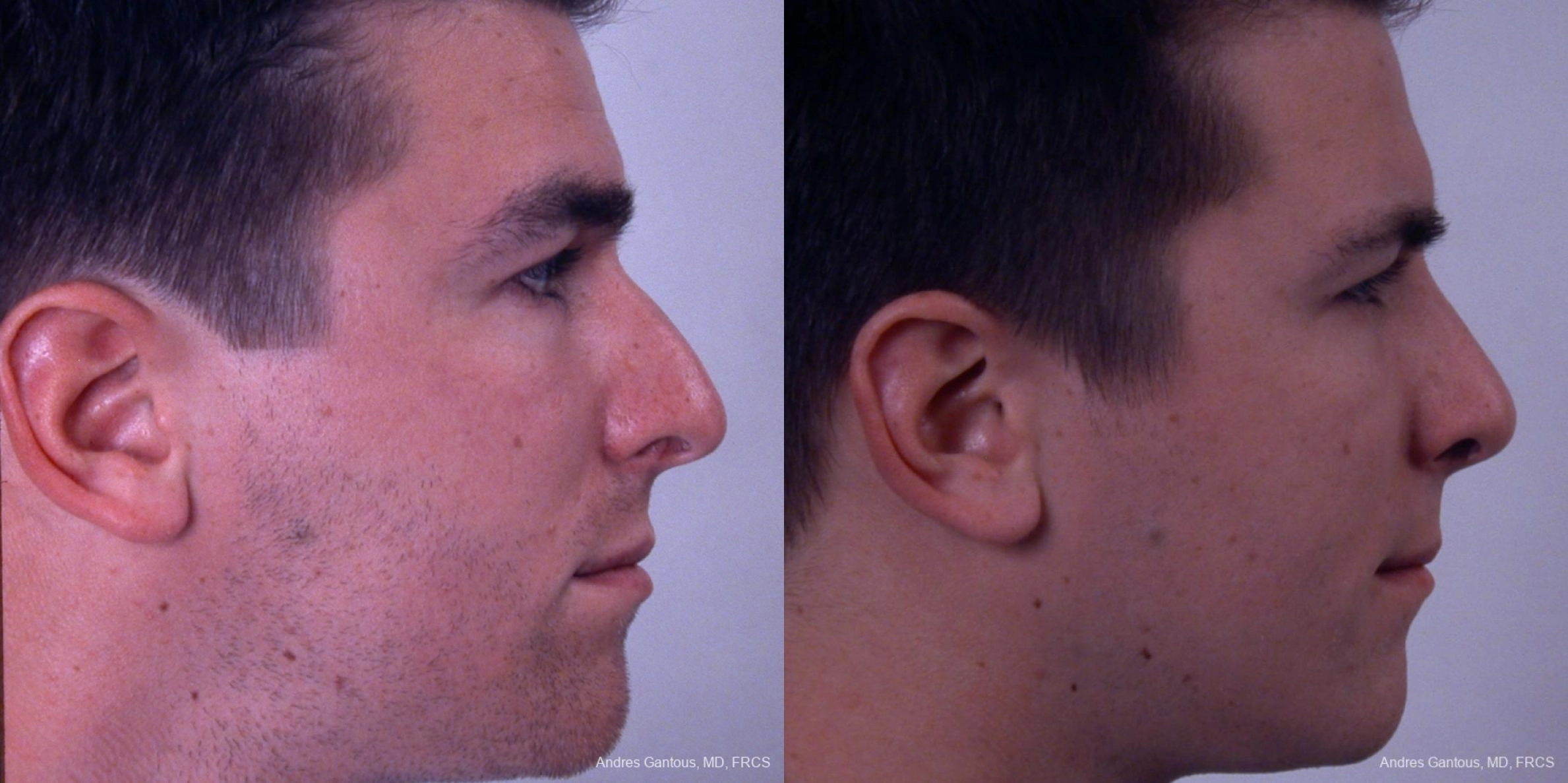 Rhinoplasty - Thumbnail 3