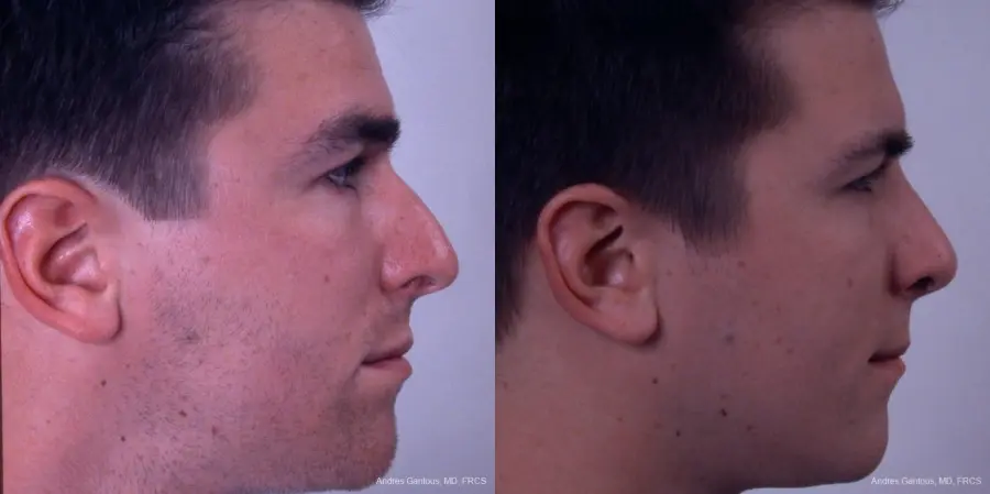 Rhinoplasty: Patient 33 - Before and After 3
