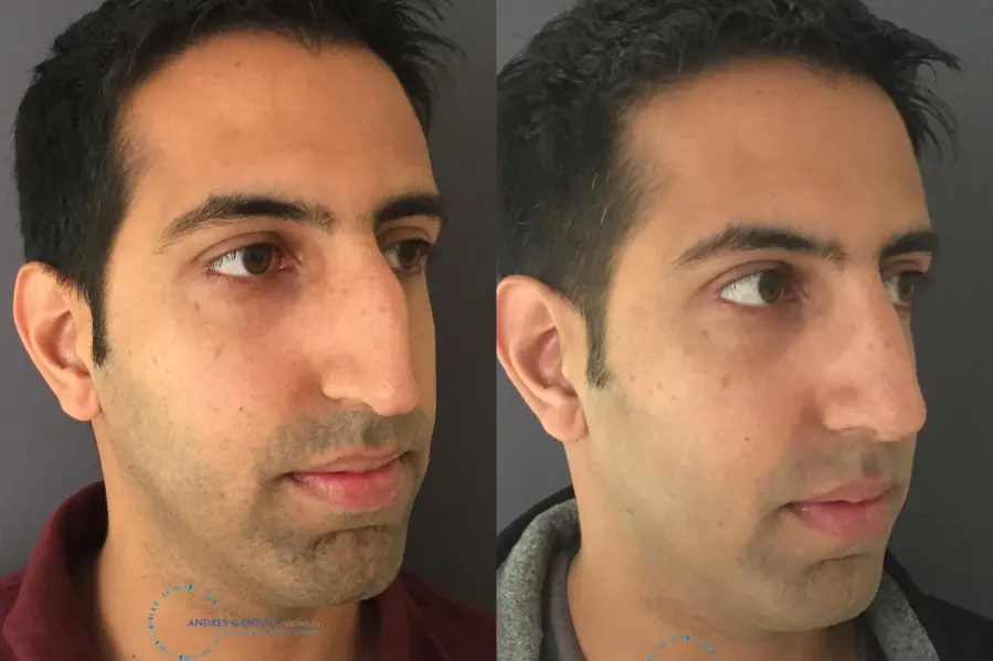Rhinoplasty: Patient 76 - Before and After 3