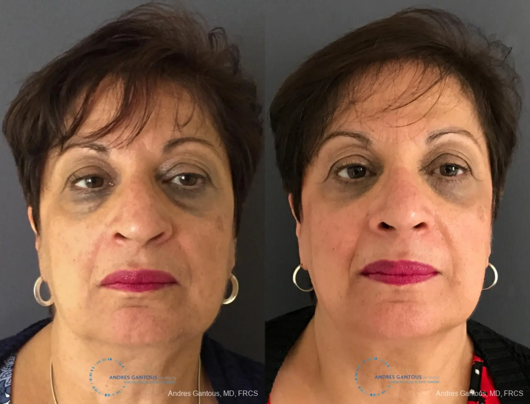 Rhinoplasty: Patient 89 - Before and After  