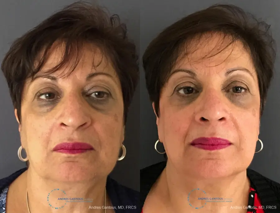 Rhinoplasty: Patient 91 - Before and After 1