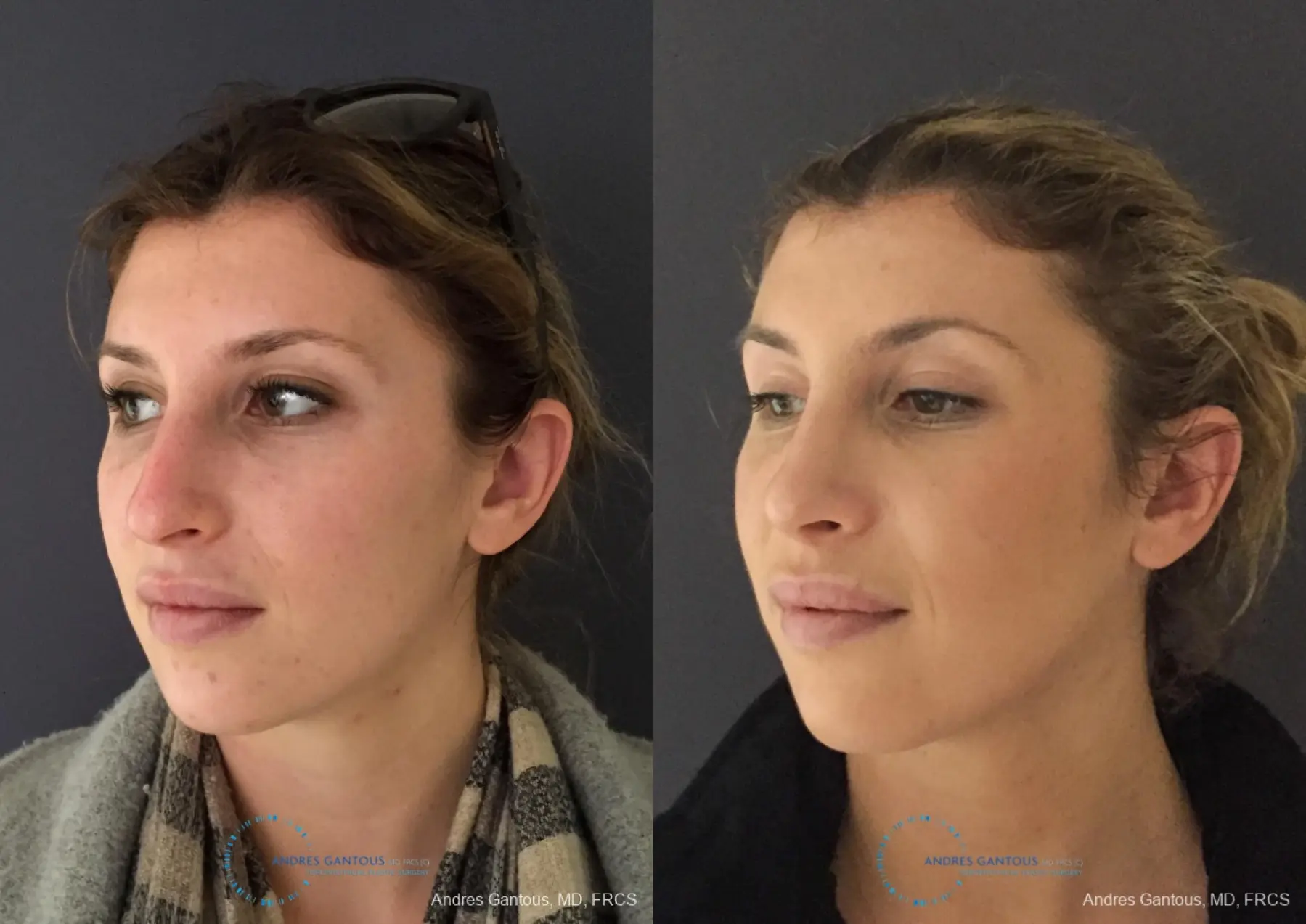 Rhinoplasty: Patient 77 - Before and After 4