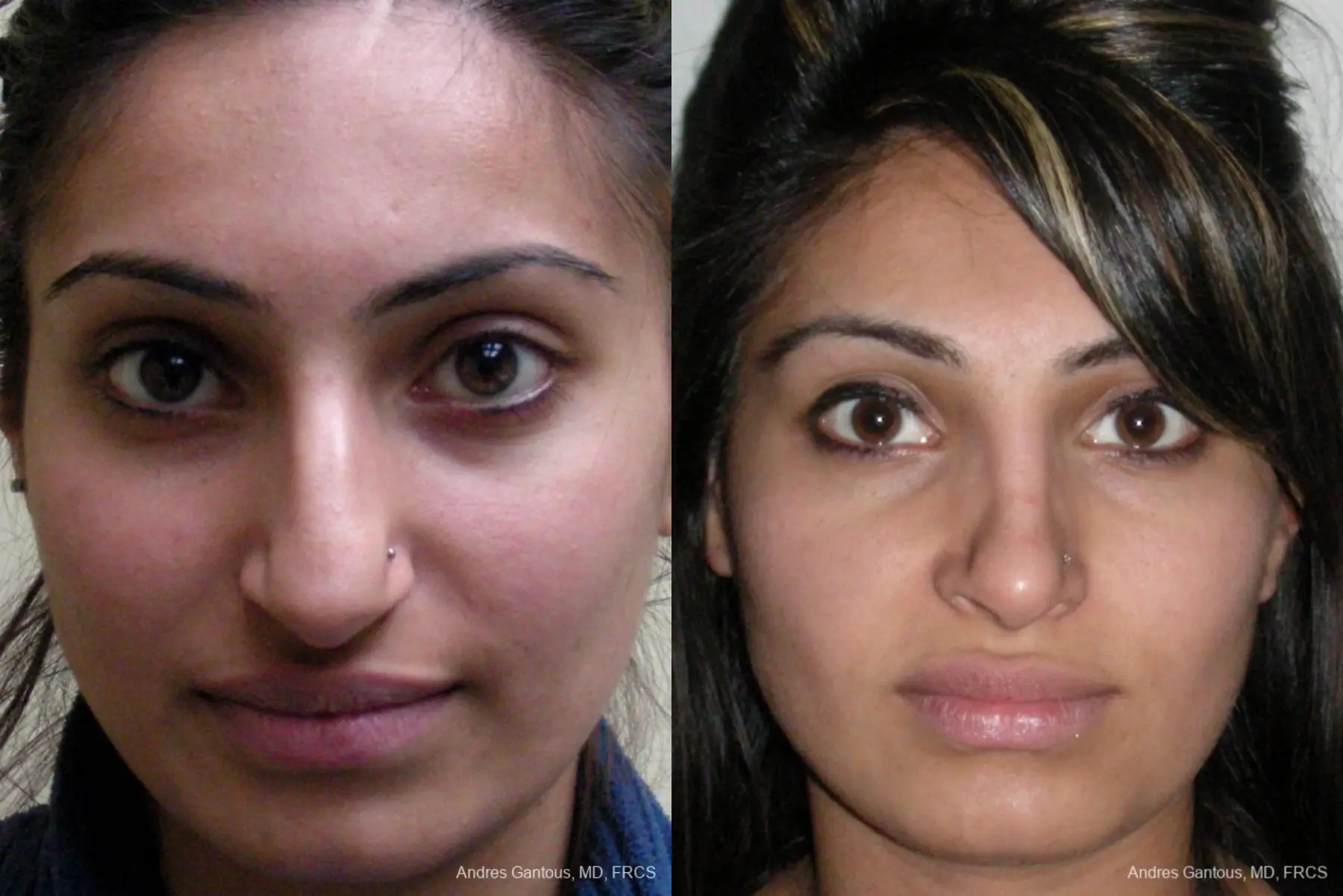 Rhinoplasty: Patient 28 - Before and After 1