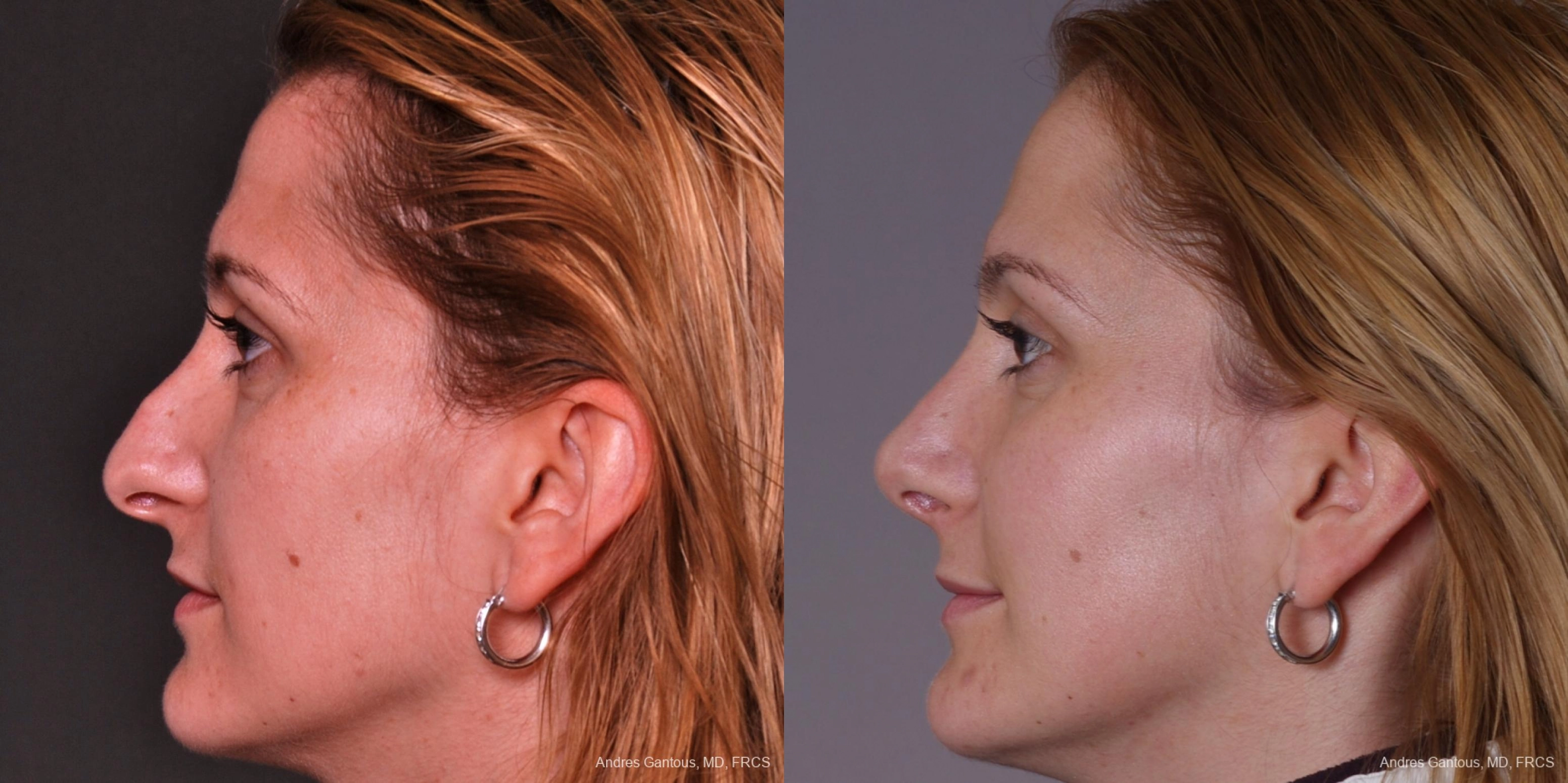 Rhinoplasty - Thumbnail 5