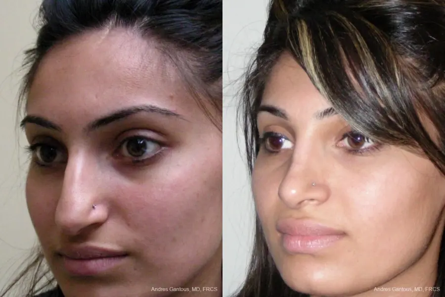 Rhinoplasty: Patient 28 - Before and After 3