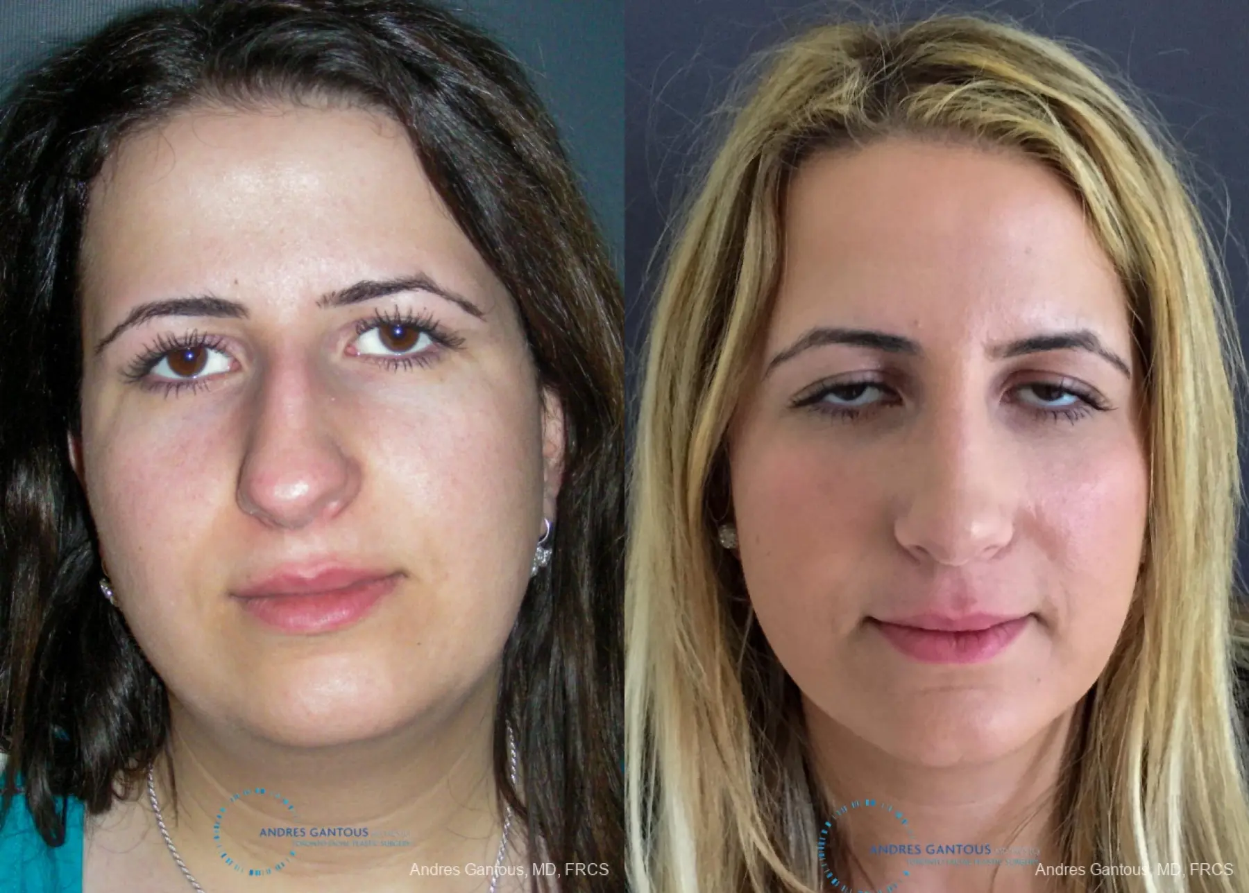 Rhinoplasty: Patient 92 - Before and After 1