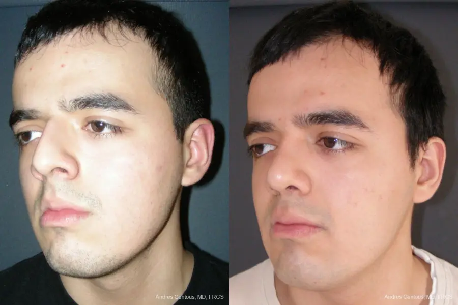 Rhinoplasty: Patient 54 - Before and After 4