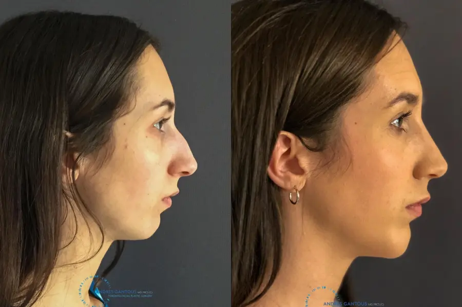 Rhinoplasty: Patient 7 - Before and After 6