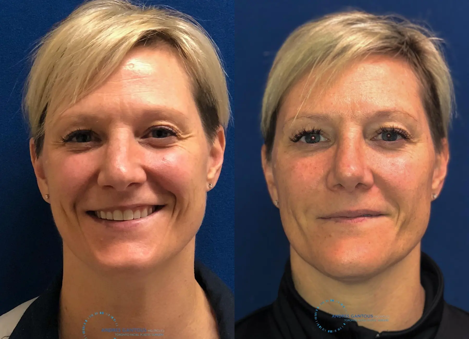 Rhinoplasty: Patient 66 - Before and After  
