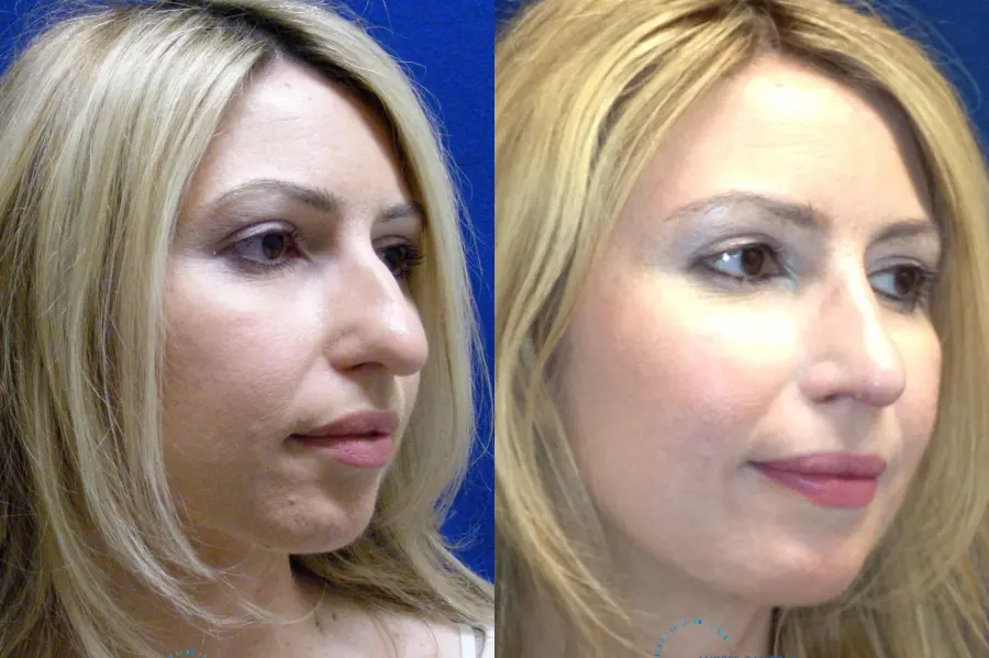Rhinoplasty: Patient 74 - Before and After 3