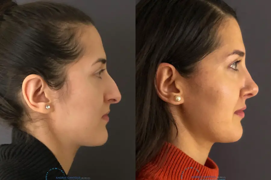 Rhinoplasty: Patient 9 - Before and After 6