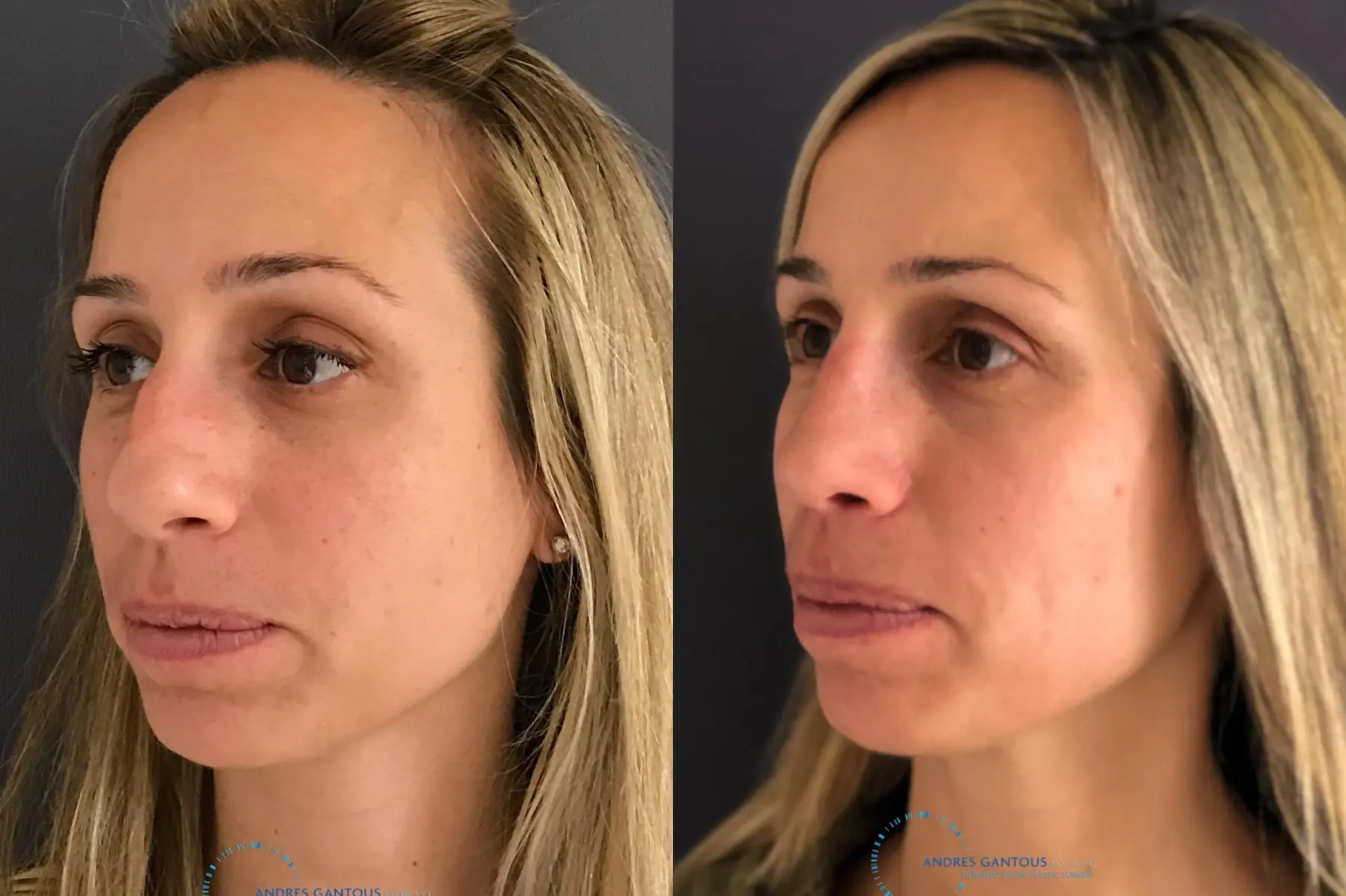 Rhinoplasty: Patient 73 - Before and After 3