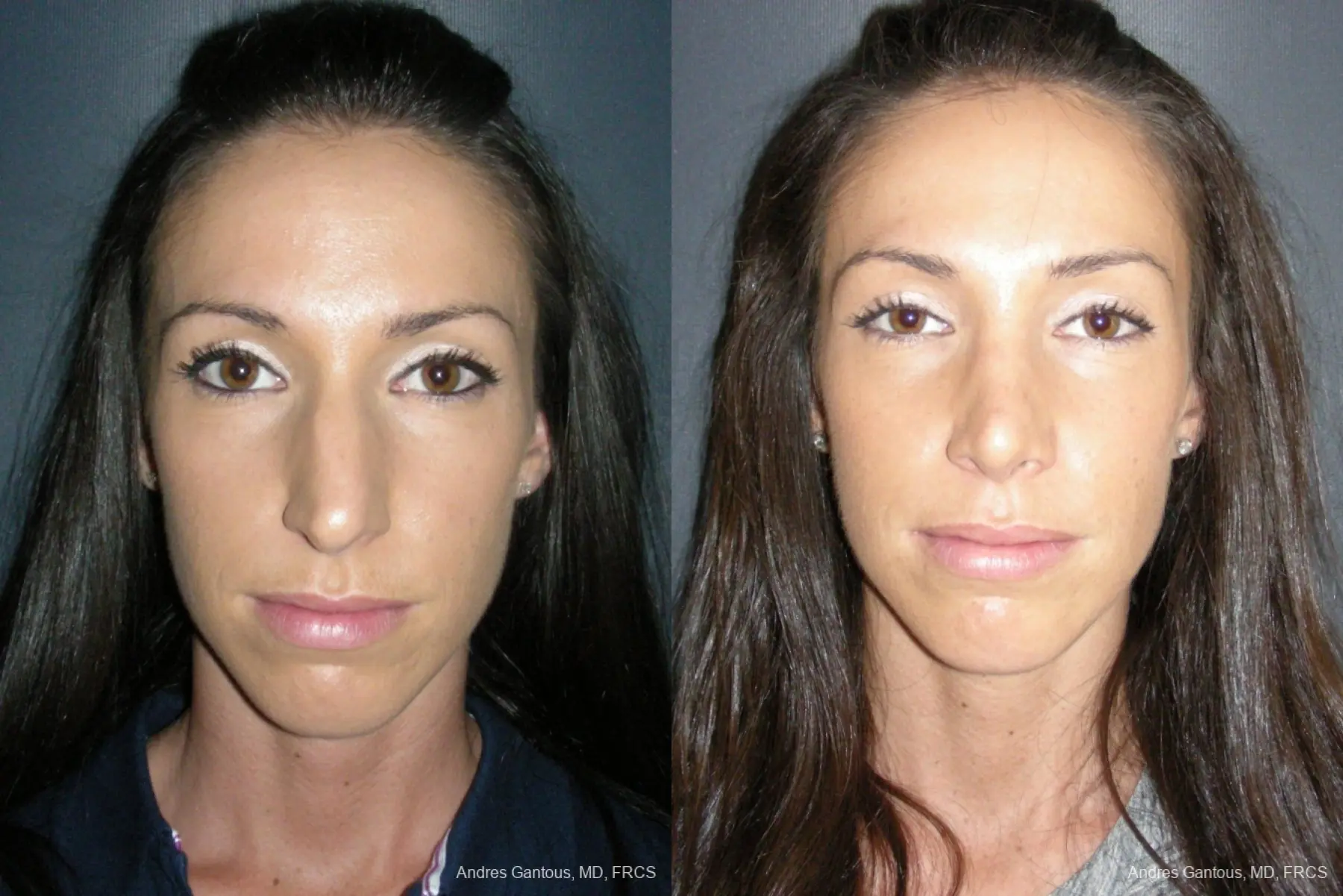 Rhinoplasty: Patient 52 - Before and After 1
