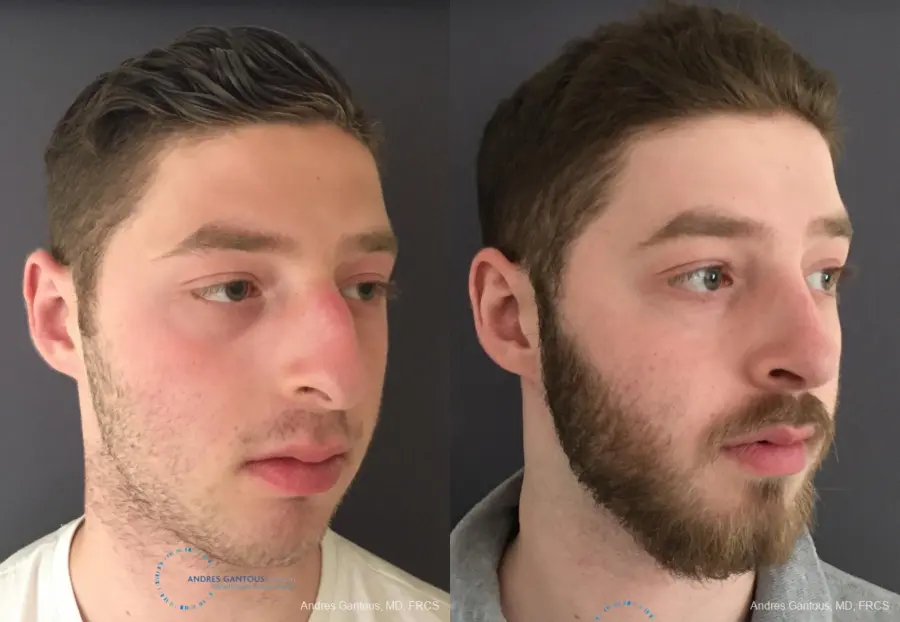 Rhinoplasty: Patient 96 - Before and After 3