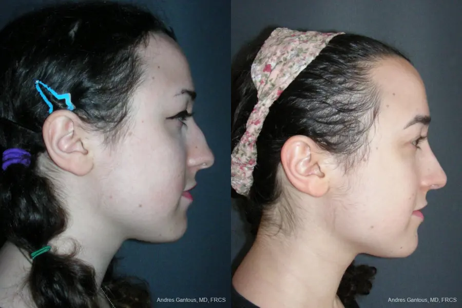 Rhinoplasty: Patient 57 - Before and After 3