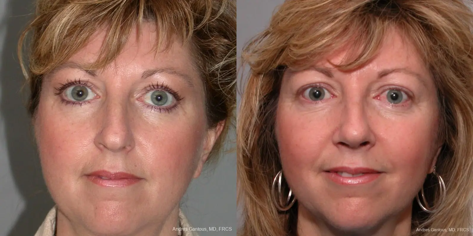 Rhinoplasty: Patient 35 - Before and After 1