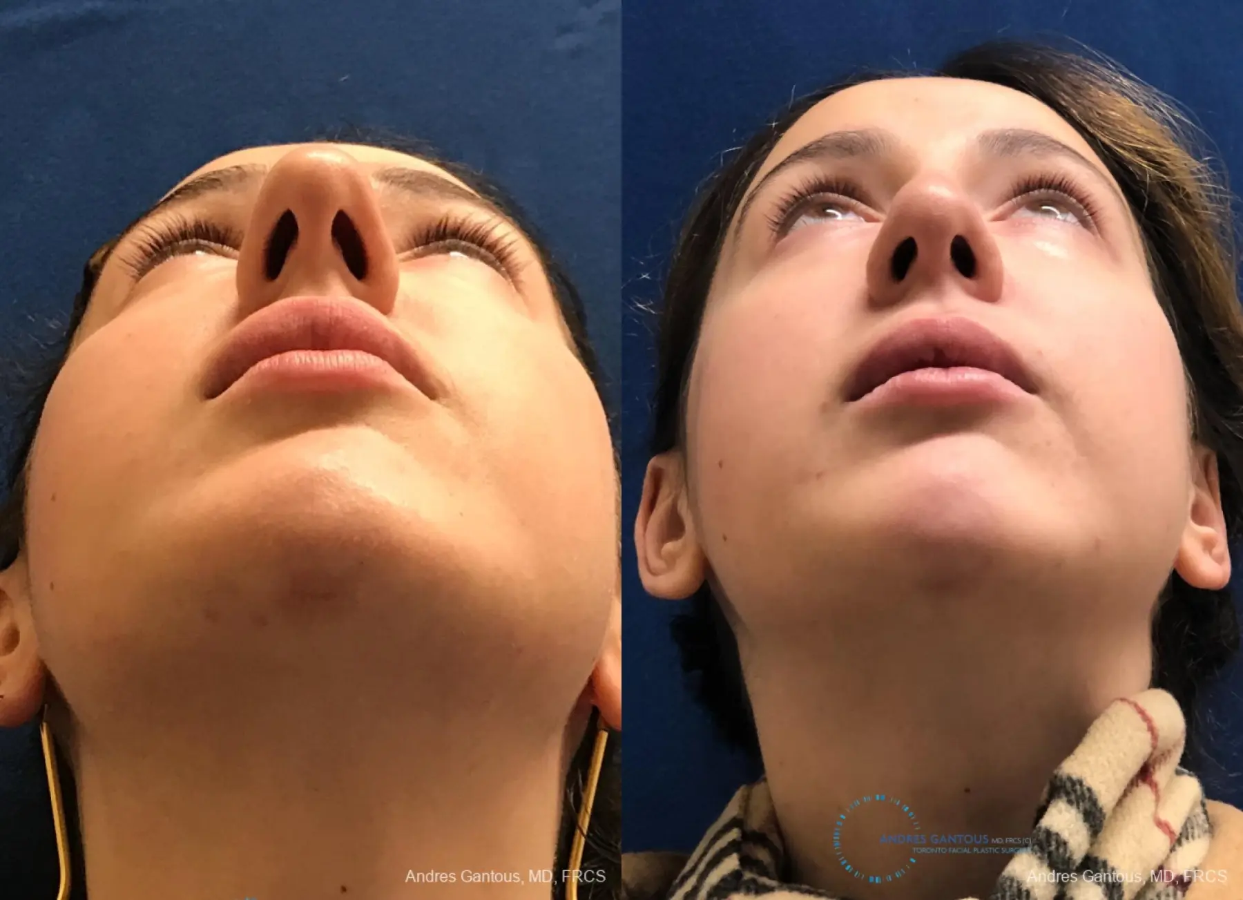Rhinoplasty: Patient 82 - Before and After 2