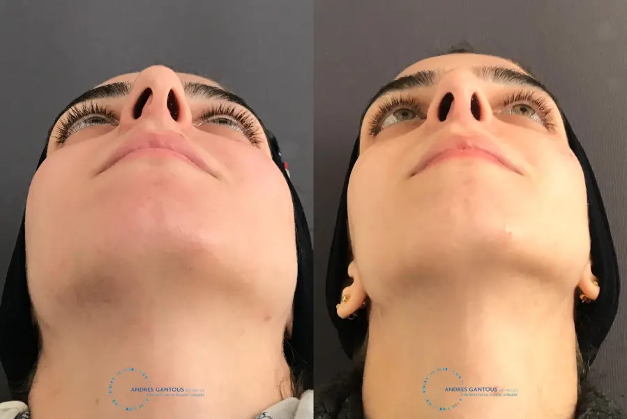 Rhinoplasty: Patient 58 - Before and After 2