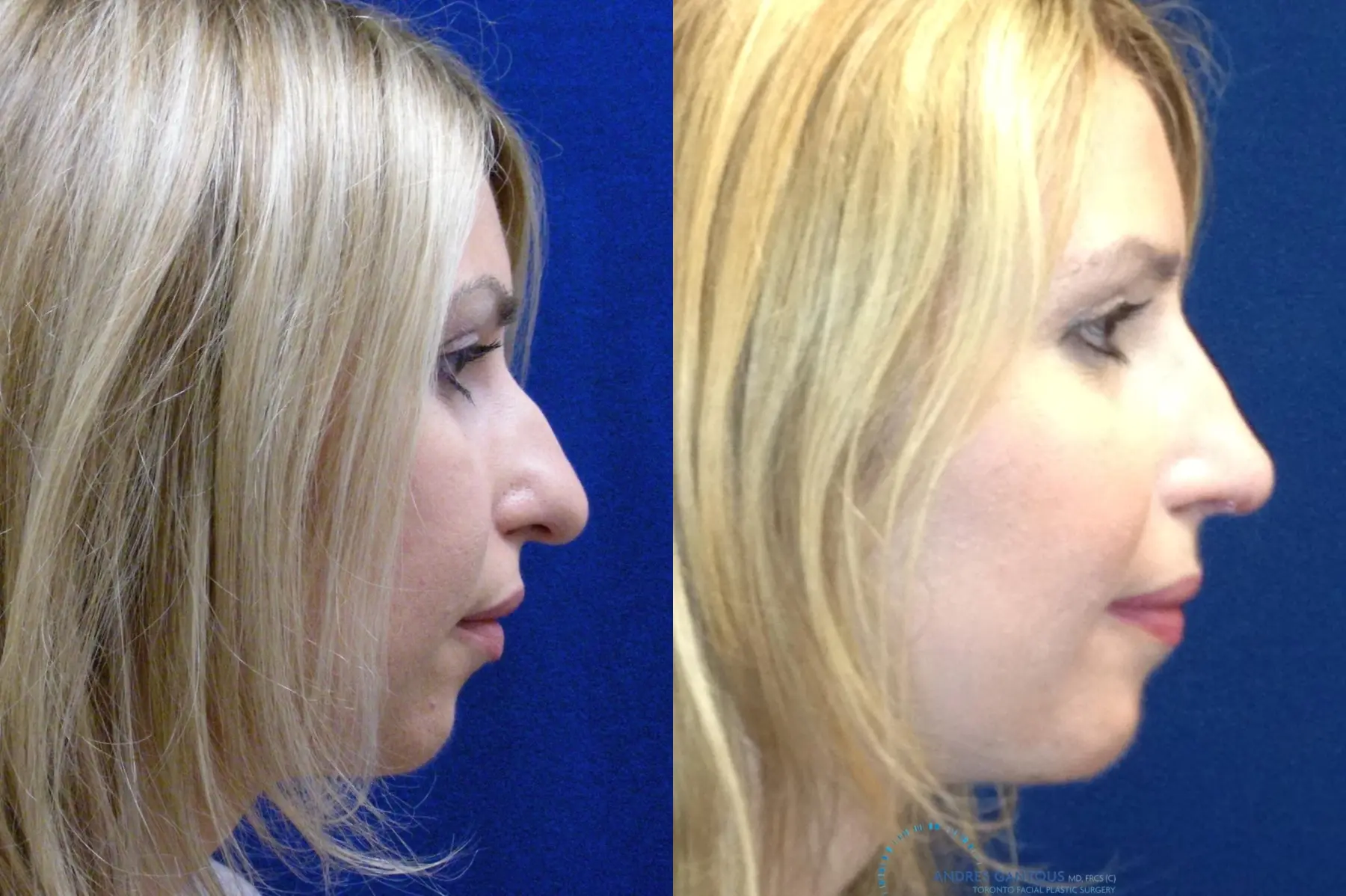 Rhinoplasty: Patient 74 - Before and After 5