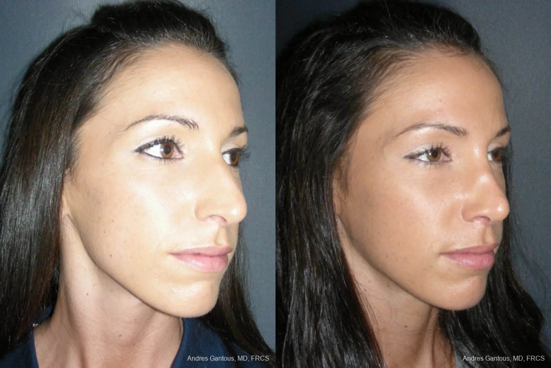 Rhinoplasty: Patient 52 - Before and After 4