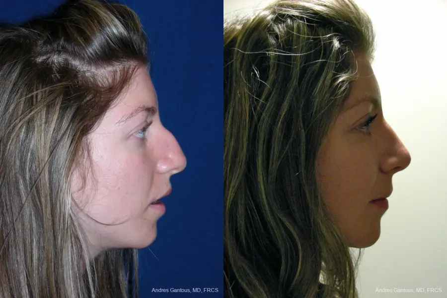 Rhinoplasty: Patient 50 - Before and After 5