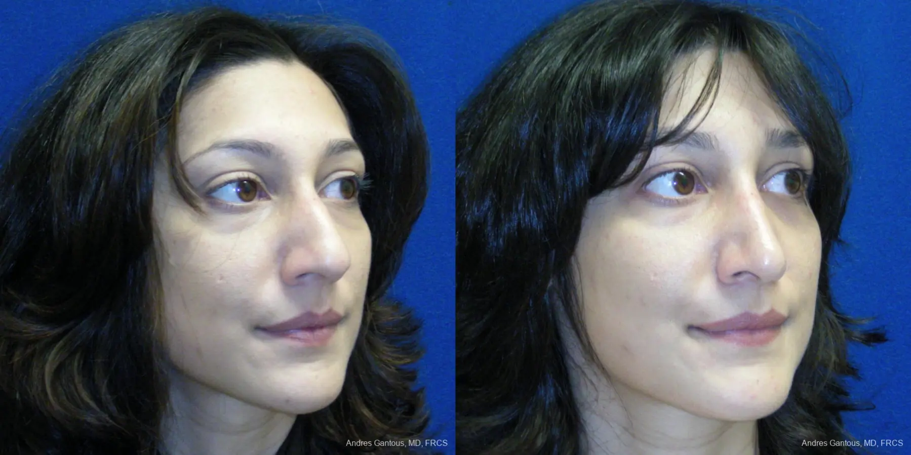 Rhinoplasty: Patient 42 - Before and After 2