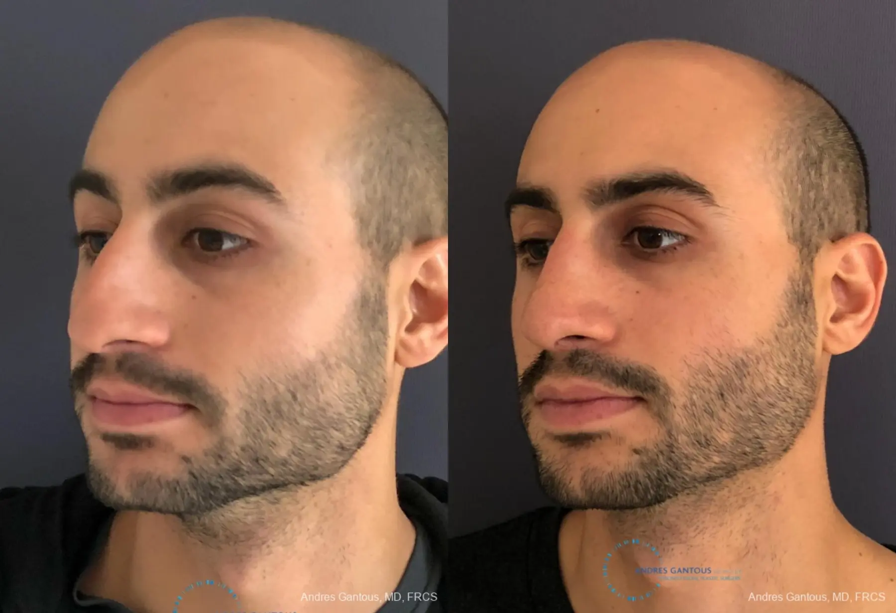 Rhinoplasty: Patient 89 - Before and After 4