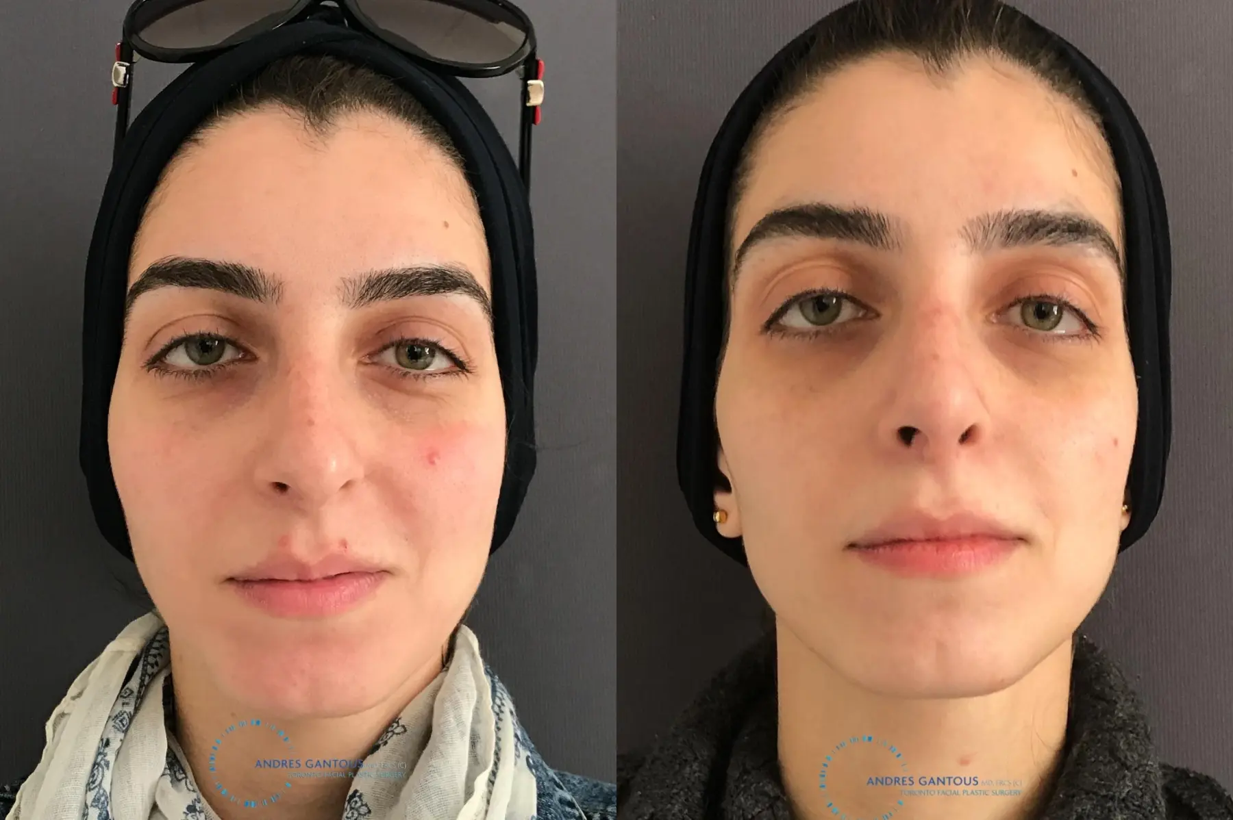 Rhinoplasty: Patient 58 - Before and After 1