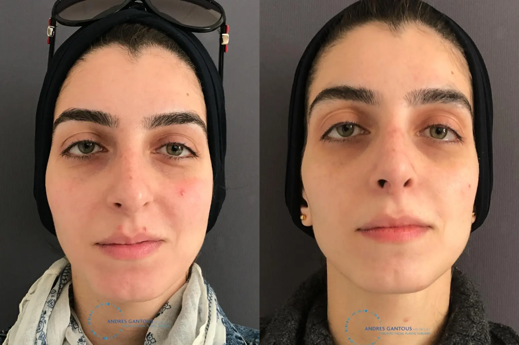 Rhinoplasty: Patient 58 - Before and After  