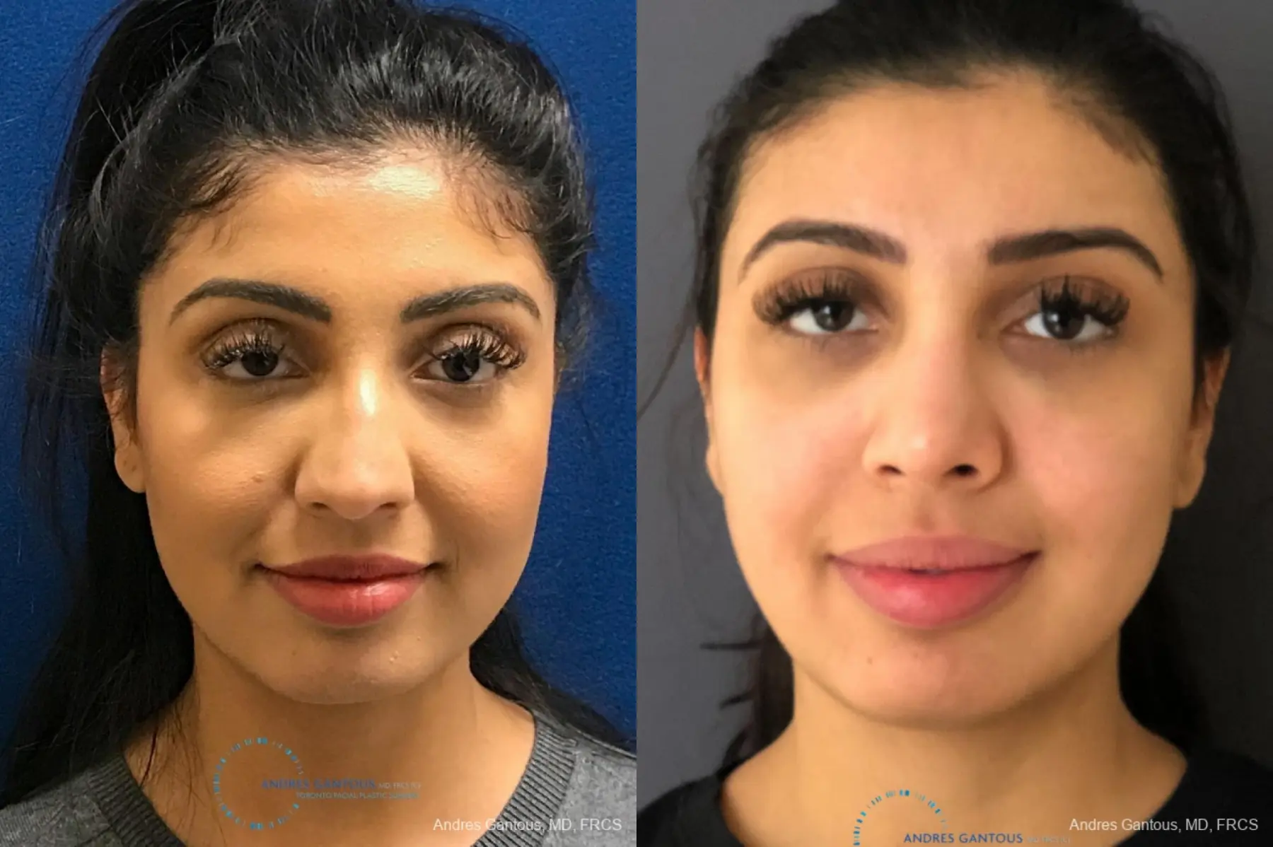 Rhinoplasty: Patient 73 - Before and After  