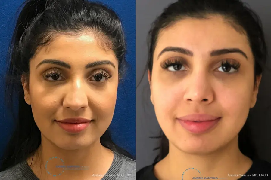 Rhinoplasty: Patient 75 - Before and After 1