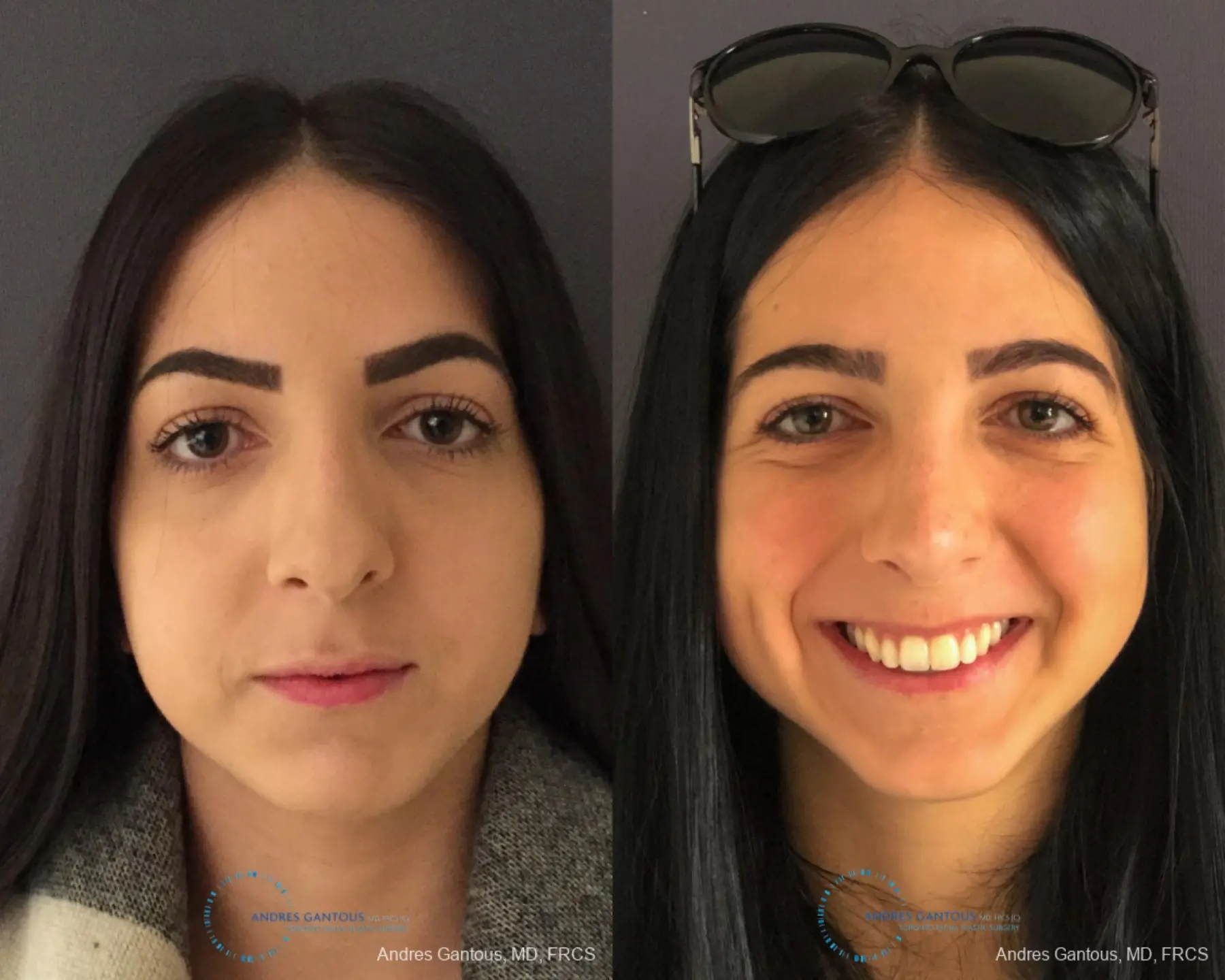 Rhinoplasty: Patient 83 - Before and After  