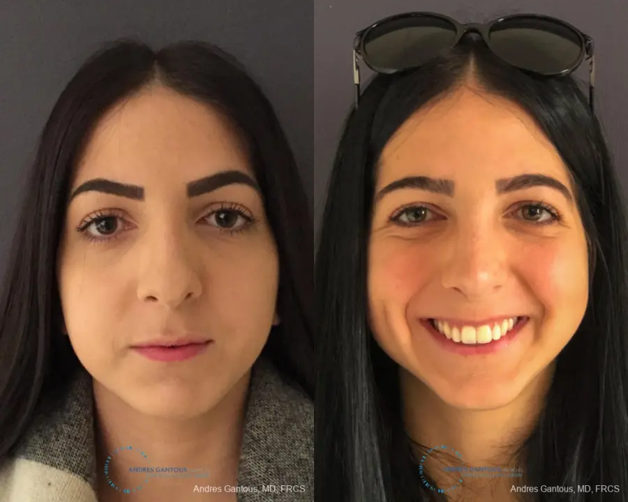 Rhinoplasty: Patient 85 - Before and After 1