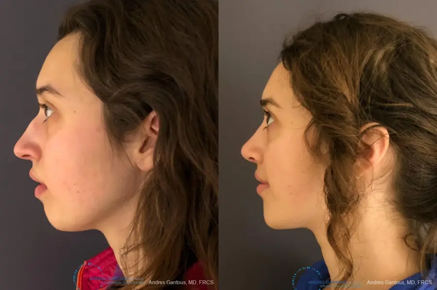 Rhinoplasty: Patient 4 - Before and After 6