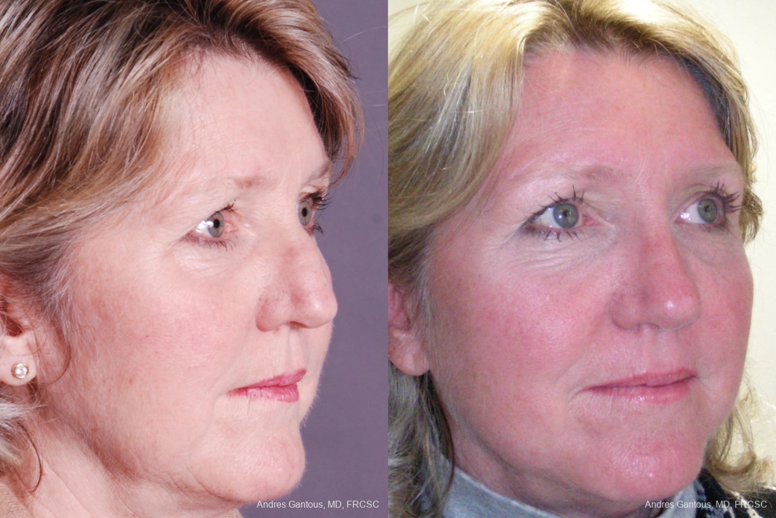 Rhinoplasty - Thumbnail 3