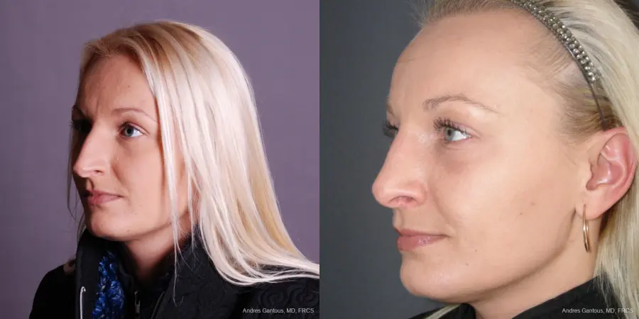 Rhinoplasty: Patient 48 - Before and After 4