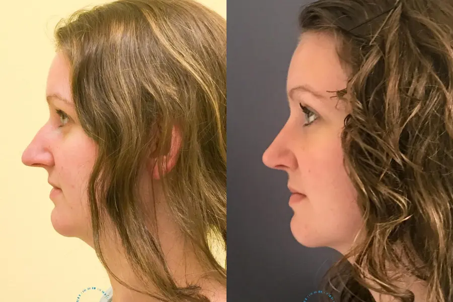Rhinoplasty: Patient 64 - Before and After 5