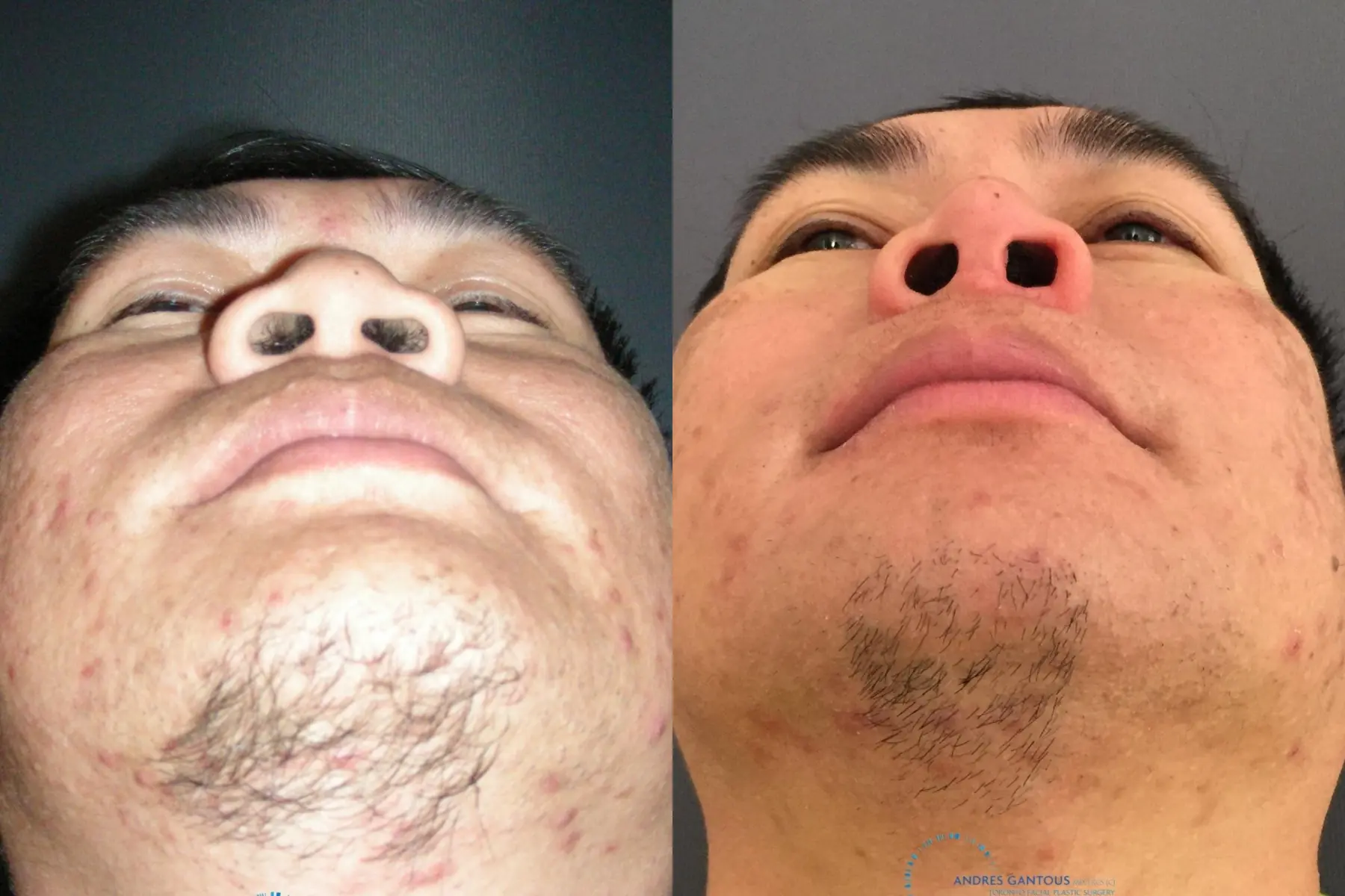 Rhinoplasty: Patient 63 - Before and After 2