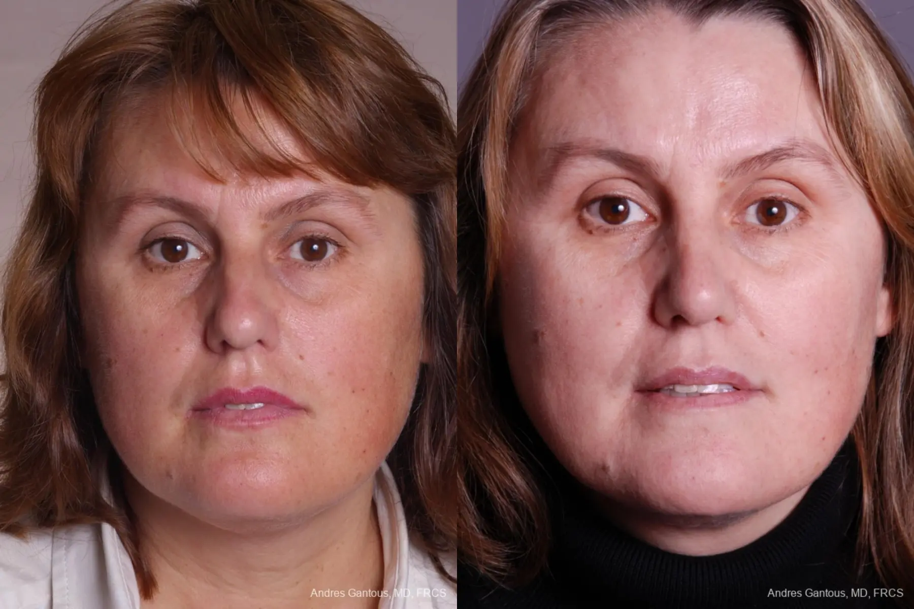 Rhinoplasty: Patient 40 - Before and After  