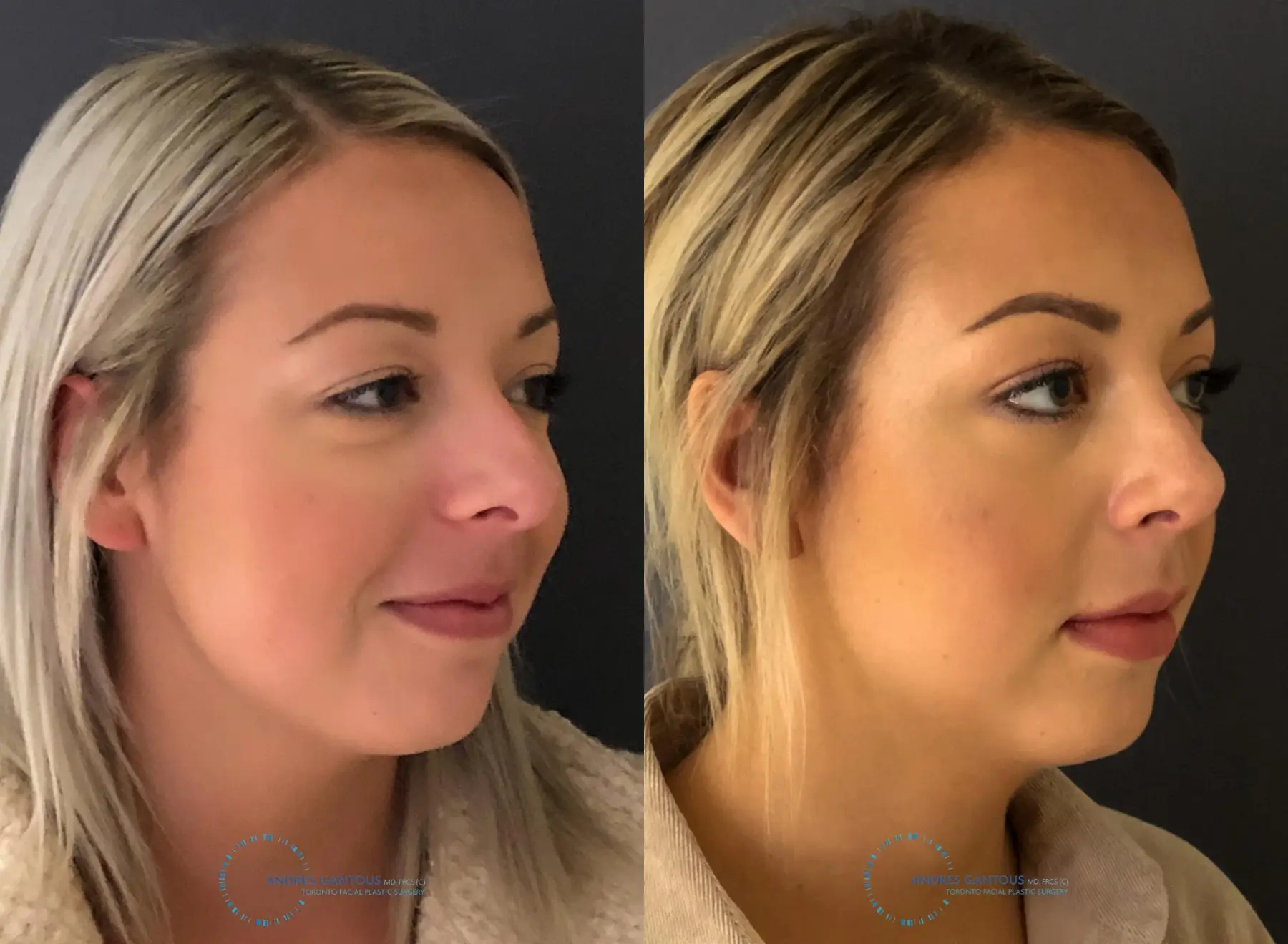 Rhinoplasty: Patient 71 - Before and After 4