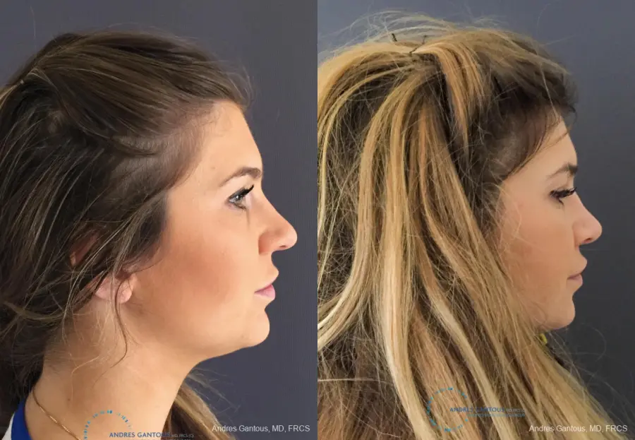 Rhinoplasty: Patient 77 - Before and After 5