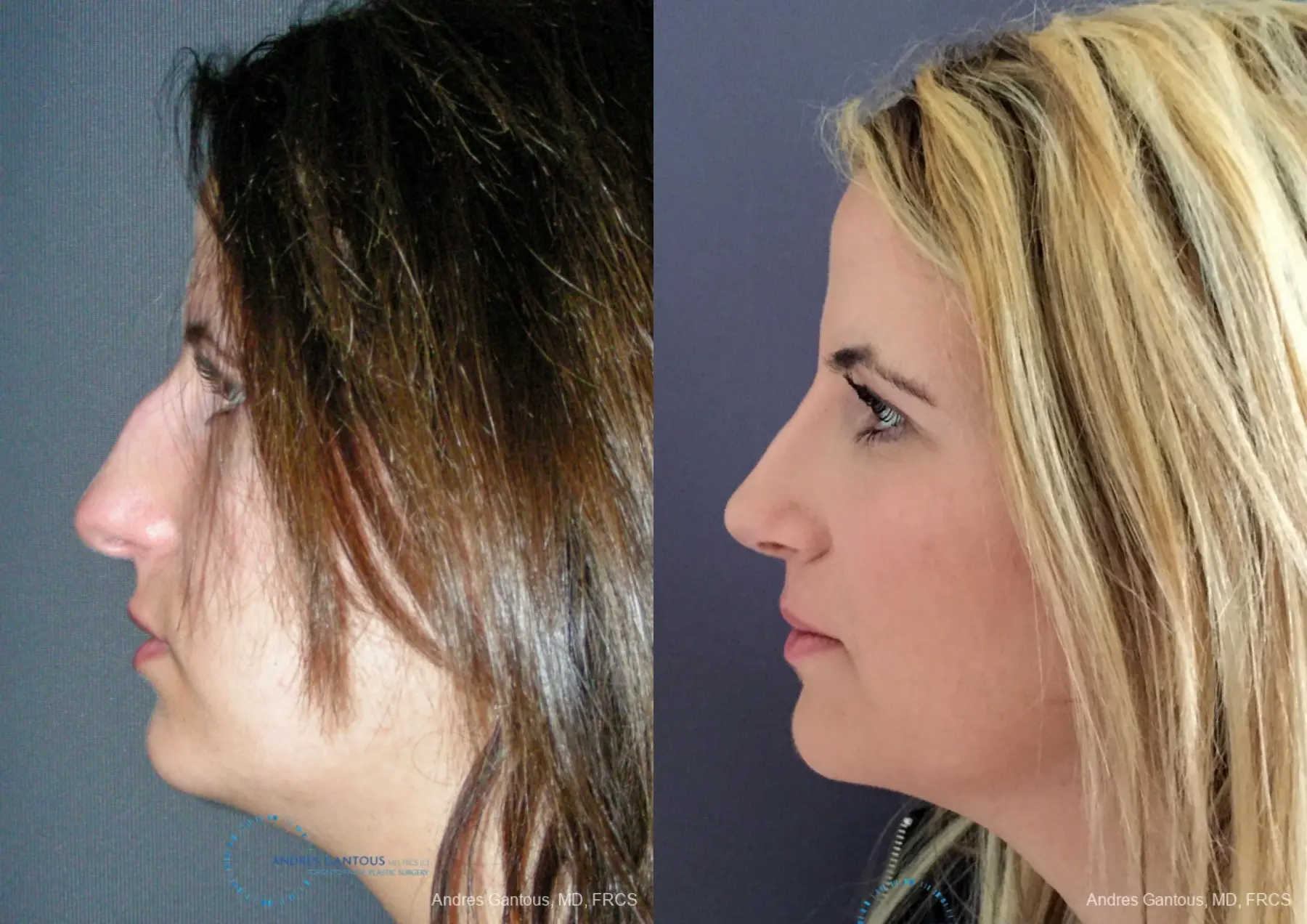 Rhinoplasty: Patient 92 - Before and After 6