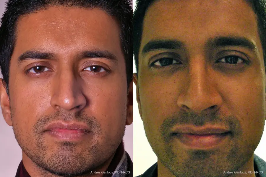 Rhinoplasty: Patient 23 - Before and After 1