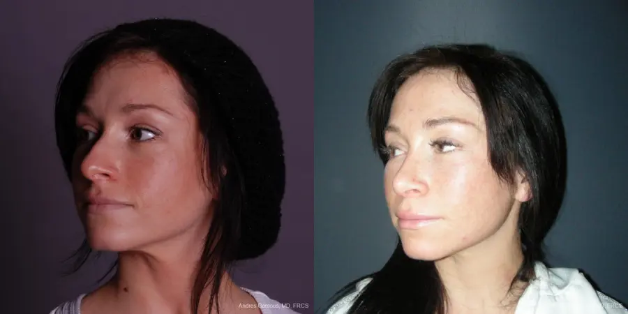 Rhinoplasty: Patient 46 - Before and After 4