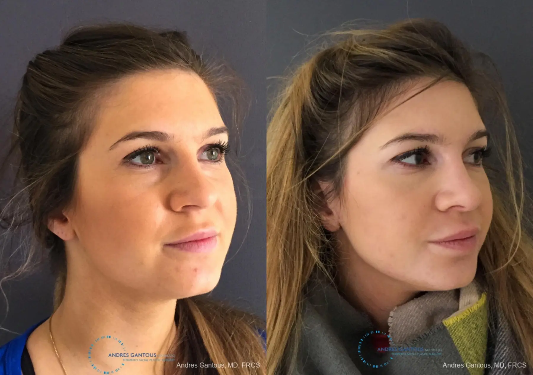 Rhinoplasty: Patient 77 - Before and After 3