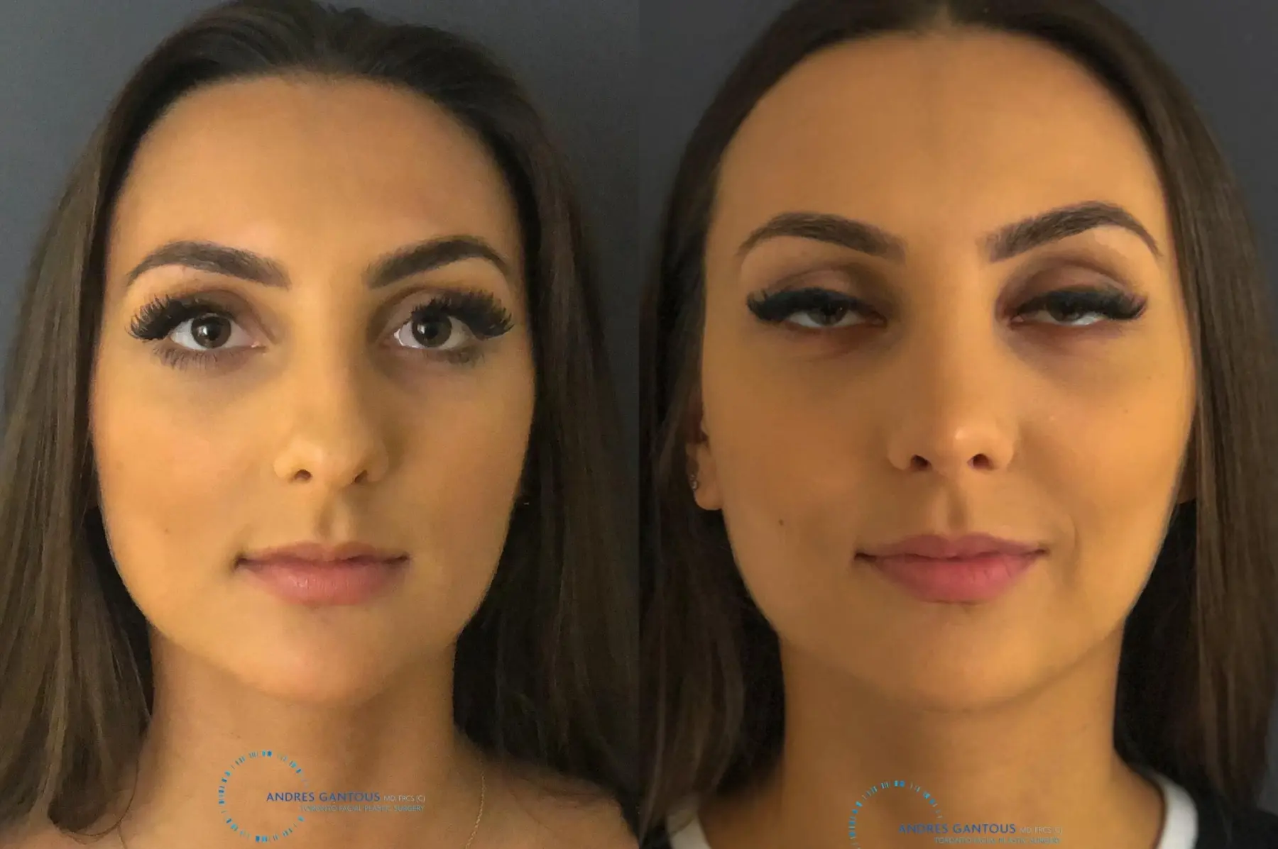Rhinoplasty: Patient 11 - Before and After 1