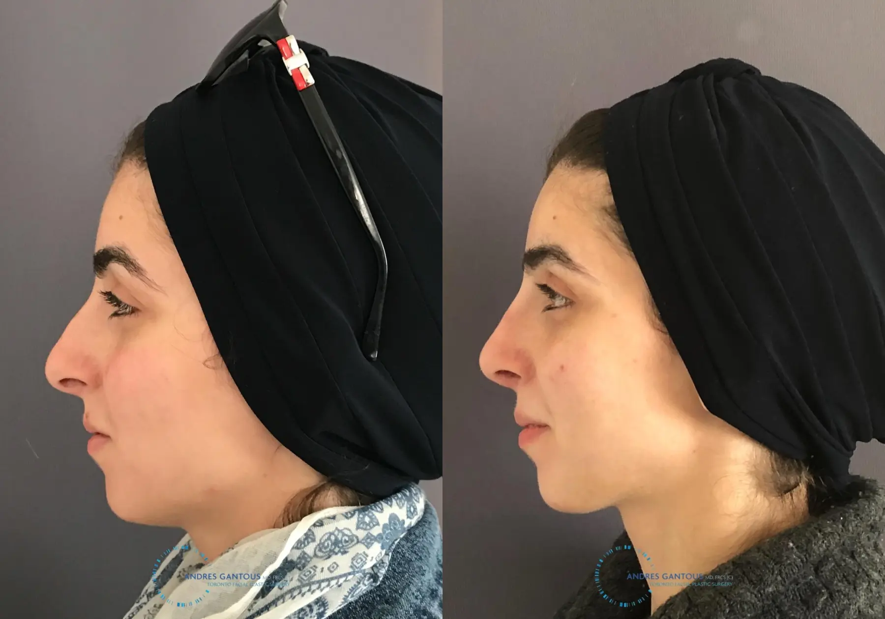 Rhinoplasty: Patient 58 - Before and After 6