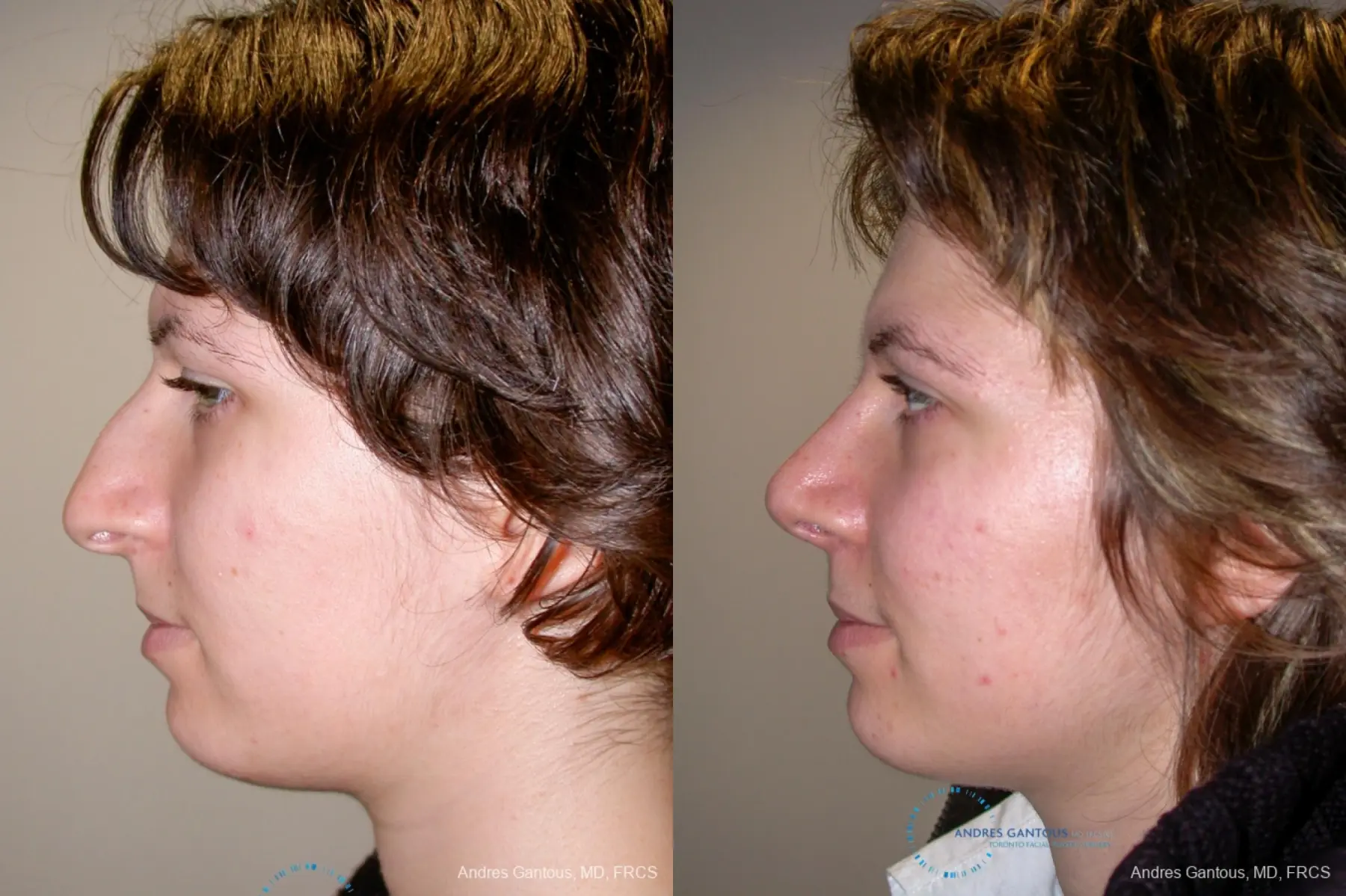Rhinoplasty: Patient 90 - Before and After 5