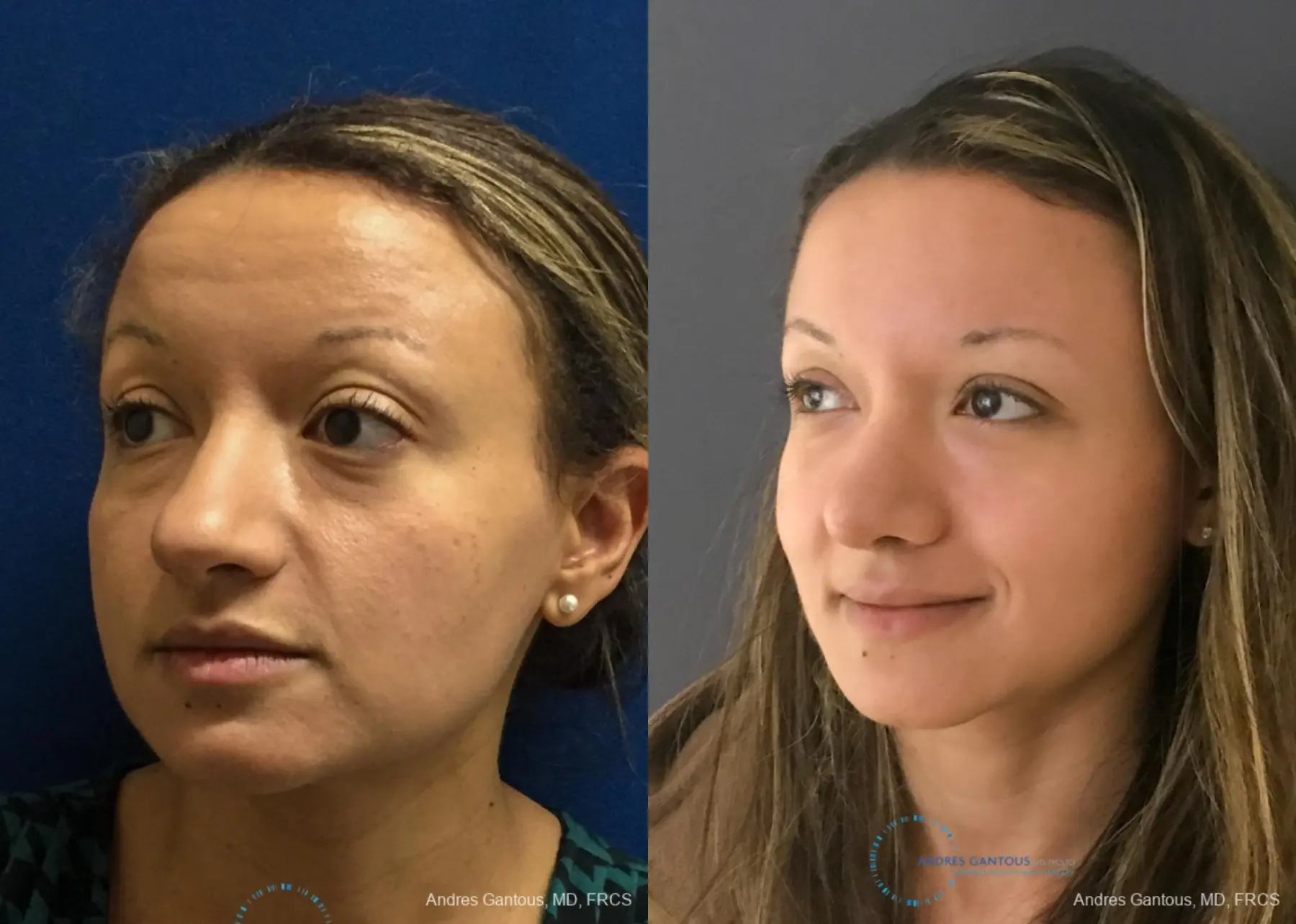 Rhinoplasty: Patient 93 - Before and After 4